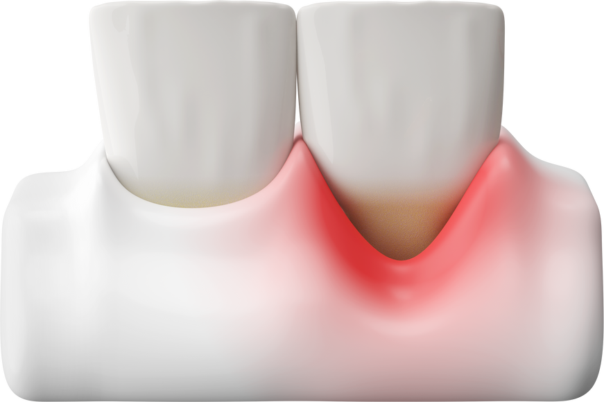 front teeth and gum recession