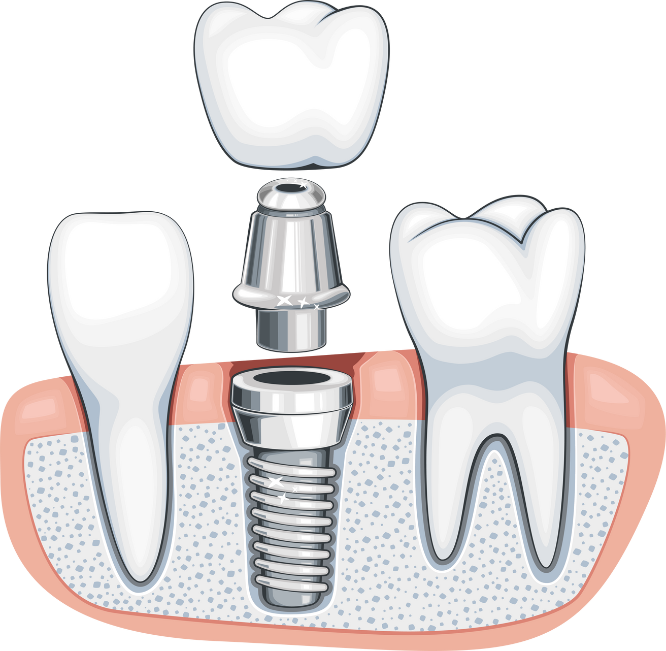 Dentist Illustration, dental implant surgery