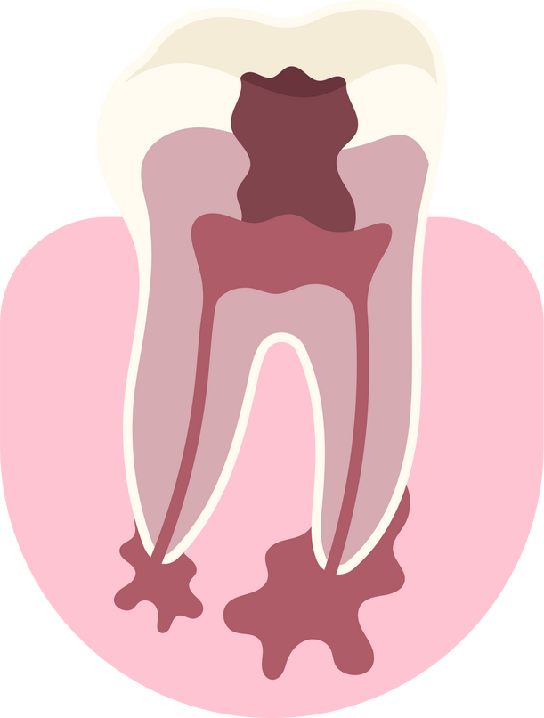 canal wisdom root implant planing crown scaling tooth dental decay procedure bridge clinic anatomy medical pulp treat pain whitening filling pus cavity hygiene Abscesses gum