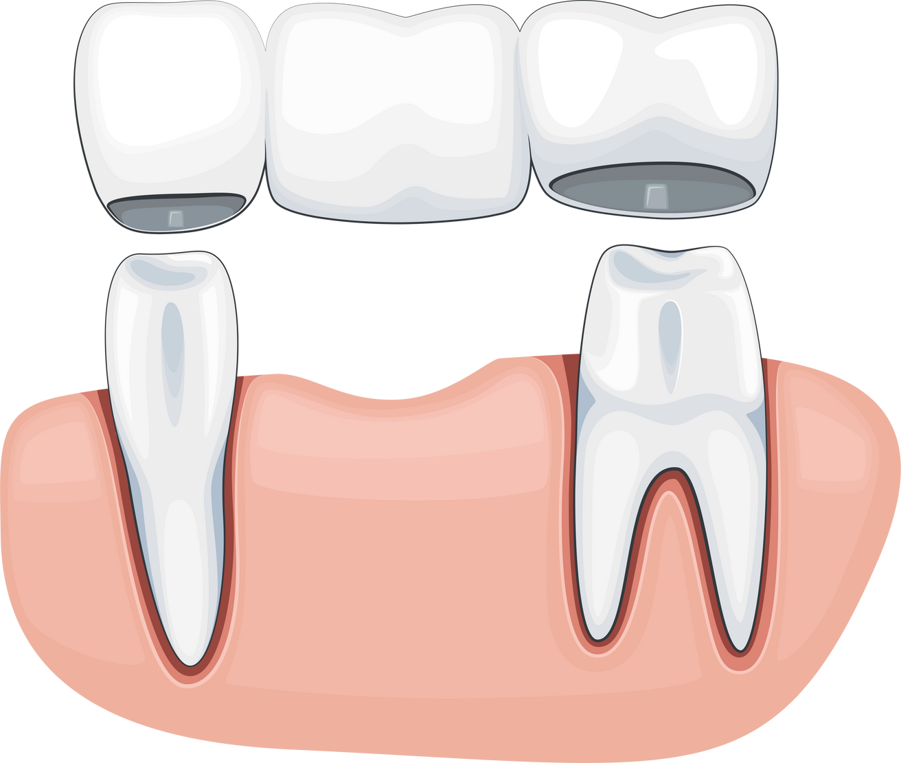 Tooth Crown Illustration, Dental Supplies